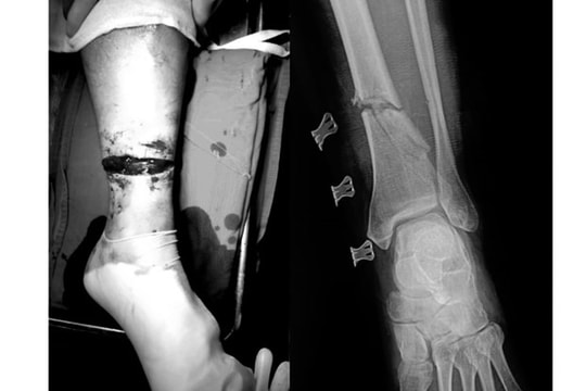 Tai nạn khi cắt cỏ, người đàn ông bị lưỡi cưa cắt đứt chân