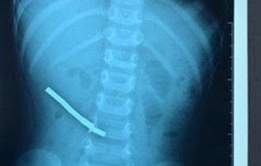 Bé trai phải cắt bỏ 20 cm ruột do nuốt 6 thỏi nam châm, 3 kim bấm