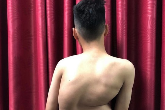 Chàng trai 17 tuổi cao thêm 8 cm sau ca mổ vẹo cột sống