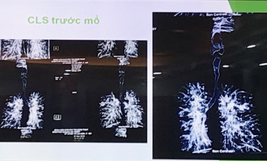 Cứu sống cô gái 18 tuổi bị sẹo khí quản bít đường thở do lao hiếm gặp