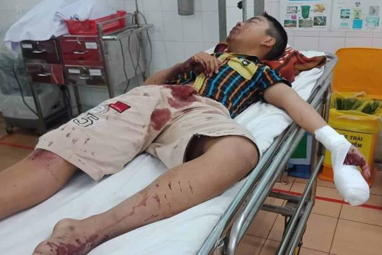 Pháo tự chế nổ ngay trên tay, thiếu niên 14 tuổi bị thương nặng