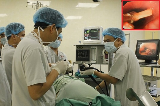 Phẫu thuật cứu sống nam bệnh nhân hóc xương gà thủng thực quản