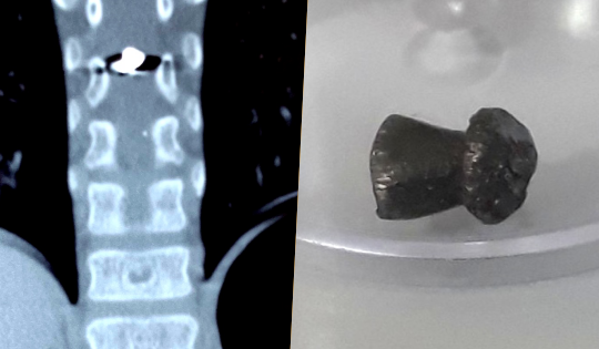 Bé 6 tuổi ở Lâm Đồng liệt 2 chân vì bị anh trai bắn súng hơi trúng lưng