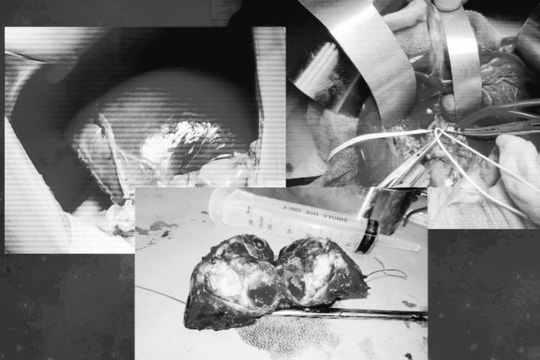 Phẫu thuật cắt gan lớn thành công cho 2 cháu bé bị ung thư