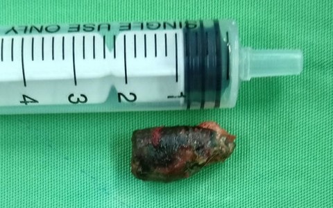 Lấy thành công đầu đạn nằm trong cơ thể người cựu chiến binh hơn nửa thế kỷ