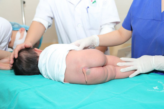 Phẫu thuật cắt bỏ thành công dị tật còn đuôi bẩm sinh ở bệnh nhi 5 tháng tuổi