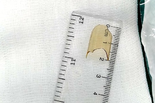 Người nhà tự móc mảnh thủy tinh trong miệng, bé 8 tháng tuổi lâm nguy