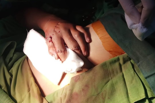 Thiếu niên 15 tuổi suýt cắt bỏ bàn tay vì đốt pháo nổ tự chế