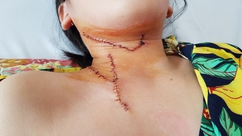 Liên tiếp trẻ bị tai nạn thương tích