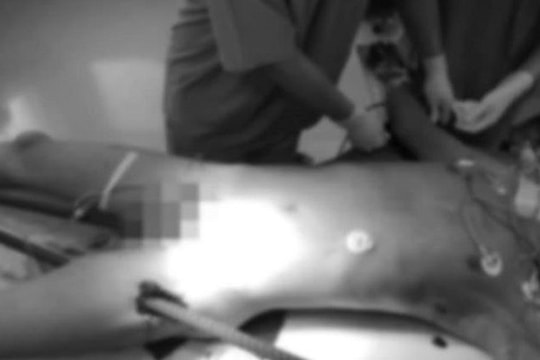 Cứu sống nam thanh niên bị 2 cọc sắt đâm xuyên người