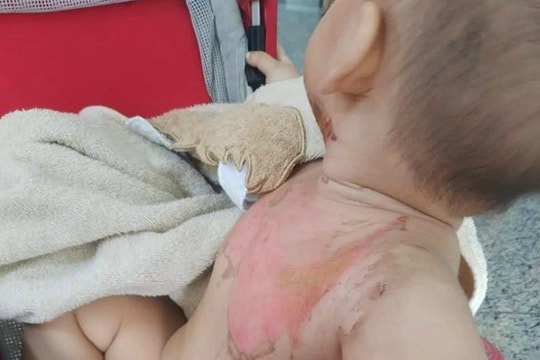 Bé trai 2 tuổi bỏng nặng vì nghịch nước sôi nấu mì tôm