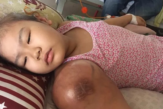 Xót xa cảnh bé gái dân tộc Tày xinh xắn bị căn bệnh ung thư xương hành hạ