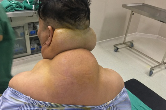 Người đàn ông bị biến dạng cơ thể sau nhiều năm nghiện rượu