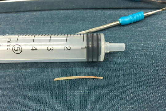 Bé gái suýt mất mạng vì trị hóc xương cá bằng cách dân gian