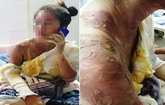 Chồng ném bình nước nóng vào vợ gây bỏng nặng: Vợ không kiện, chồng có 'thoát án'?