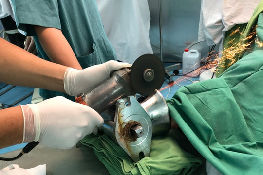 Người phụ nữ bị máy xay thịt nghiền nát bàn tay