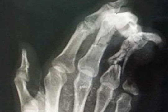 Điện thoại phát nổ, nam thanh niên bị dập nát bàn tay