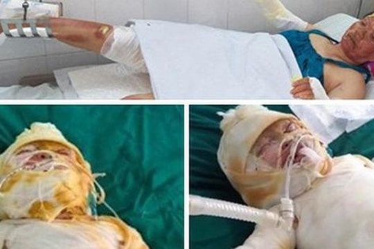 3 mẹ con bị bỏng nặng sau vụ cháy điều hòa cần sự cứu giúp của nhà hảo tâm