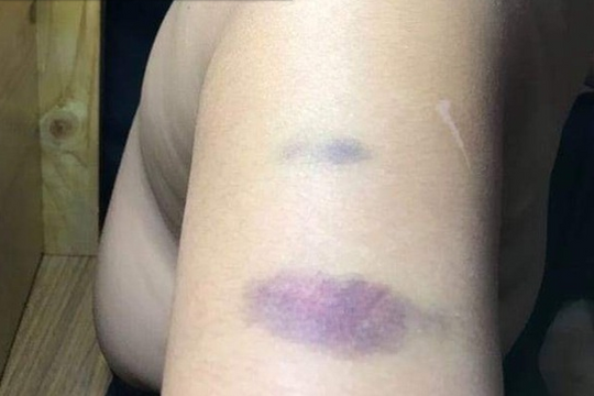 Cô giáo trường quốc tế đánh học sinh lớp 4 bầm cánh tay