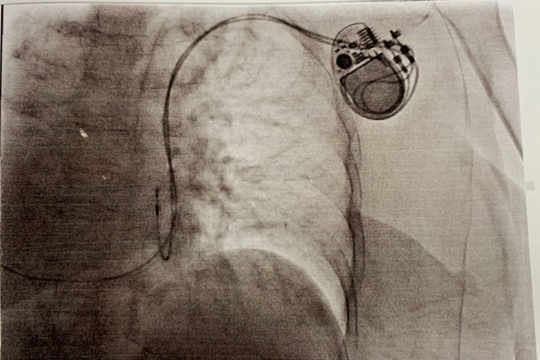 Cứu sống cụ bà có trái tim nằm bên phải, nguy kịch vì nhịp tim chậm