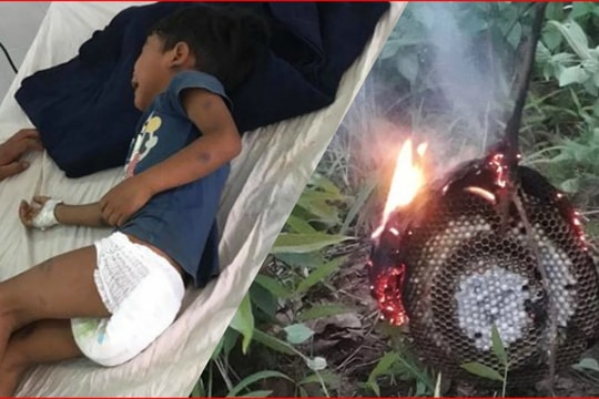 Ong đốt 2 anh em ruột, bé 3 tuổi tử vong, bé 5 tuổi nguy kịch