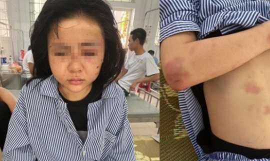 Kết quả giám định của cô gái bị thanh niêm xăm trổ hành hung suốt nhiều giờ ở Yên Bái