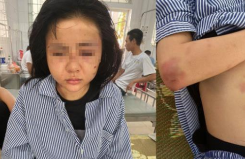 Khởi tố gã trai cuồng yêu đánh đập bạn gái suốt 2 tiếng ở Yên Bái