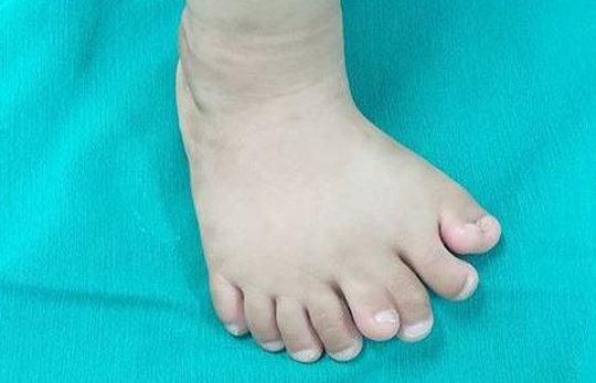 Phẫu thuật thành công cho bé trai 11 tháng tuổi có 9 ngón chân trên một bàn