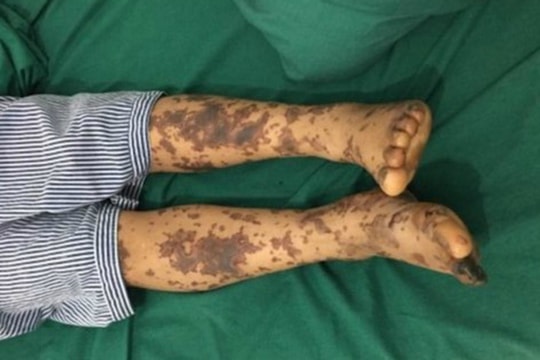 Ăn nem chua, người phụ nữ bị nhiễm liên cầu lợn