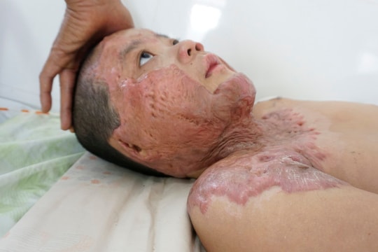 Sẹo co kéo khiến bé trai 8 tuổi bị bỏng xăng không thể quay nổi đầu