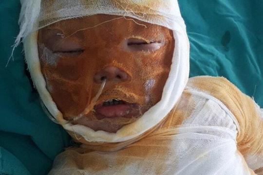 Xót xa bé trai 4 tuổi bị bỏng nặng không có tiền phẫu thuật