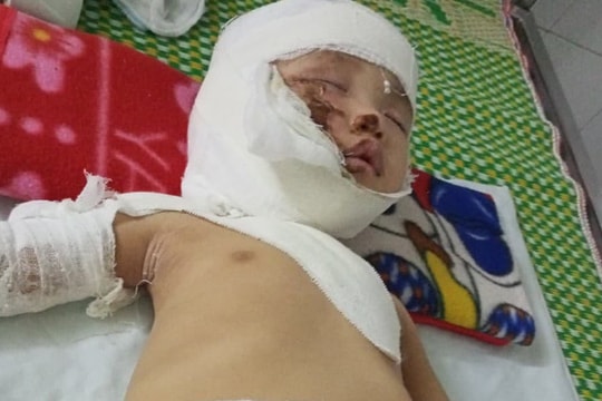Ngã vào bếp lửa khi đang tập đi, bé gái 9 tháng tuổi bị bỏng nặng