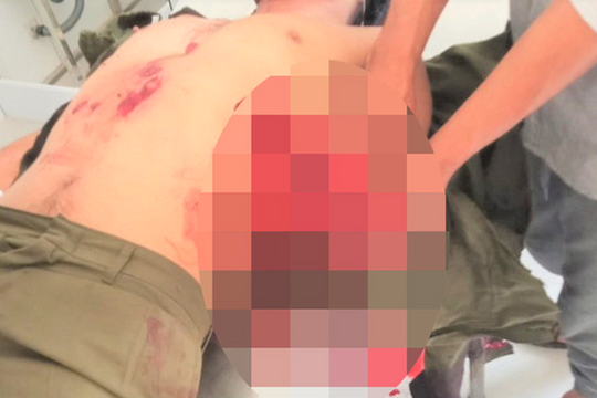 Mìn đánh cá tự phát nổ, 7 người bị thương