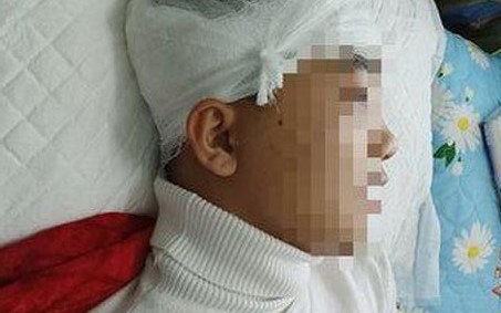 Bắt giam đối tượng đánh nam sinh lớp 11 chấn thương sọ não