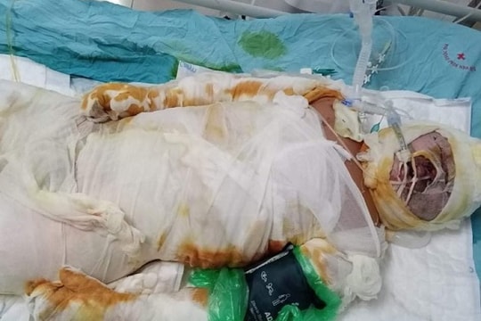 Thương tâm hai mẹ con vùi trong “biển lửa”, mẹ qua đời, con nguy kịch tính mạng vì bỏng nặng
