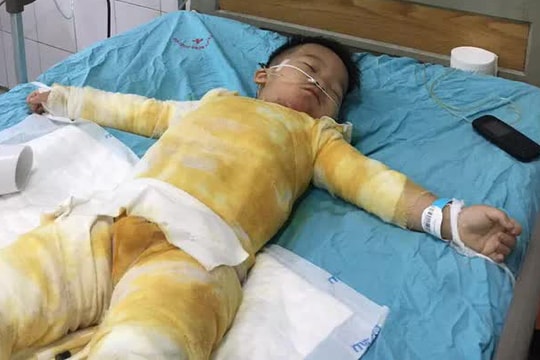 Ngã vào nồi canh, bé trai 3 tuổi bị bỏng nặng nguy kịch khi gia đình khó khăn