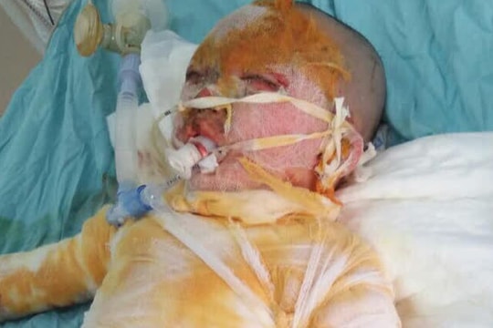 Cơ thể biến dạng, mặt loang lổ do bỏng cồn, bé gái 5 tuổi khẩn thiết cần sự giúp đỡ