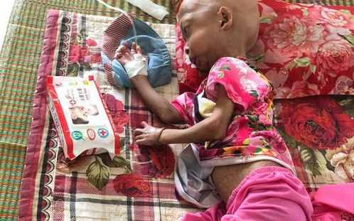 Xót xa bé gái dân tộc chân tay teo tóp, đầu không cọng tóc vì bệnh lạ không tiền điều trị