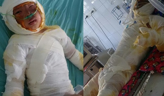 Hai cha con cùng lúc nguy kịch vì bỏng nặng cần sự giúp đỡ