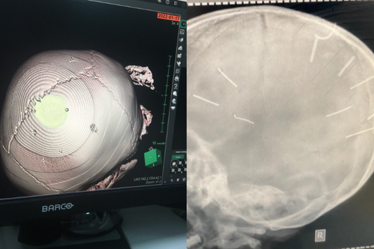Thông tin mới nhất về vụ bé gái 3 tuổi có 9 vật thể giống đinh găm trong đầu