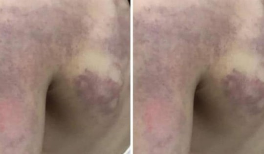 Nghệ An: Xử lý nghiêm cô giáo đánh học sinh lớp 3 bầm tím