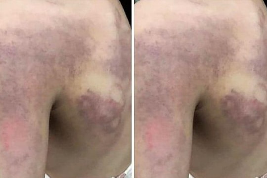 Những vụ giáo viên đánh học sinh khiến dư luận phẫn nộ 