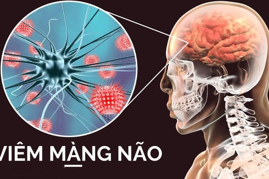 Biểu hiện giống cúm, viêm màng não có thể gây tử vong trong 24 giờ