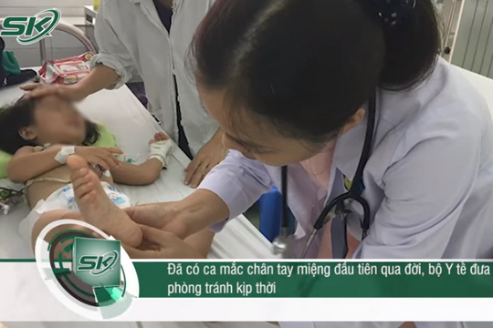 Có ca tử vong do mắc bệnh tay chân miệng, Bộ Y tế đưa ra 6 lưu ý phòng tránh kịp thời
