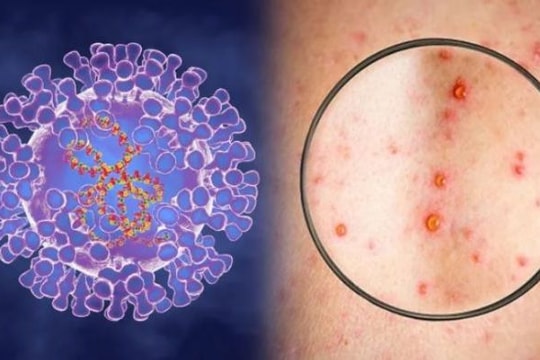 Phát hiện 2 chủng đậu mùa khỉ, gần 1.000 ca mắc trên thế giới 