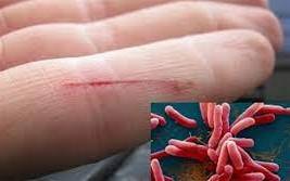 Sáng 10/6: Bộ Y tế cảnh báo khẩn sau vụ nữ sinh nhiễm 'vi khuẩn ăn thịt người'