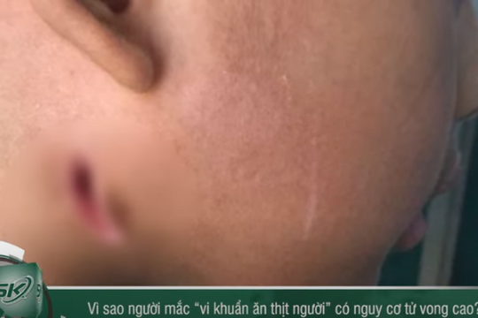 Báo động: Người mắc 'vi khuẩn ăn thịt người' có nguy cơ tử vong cao 