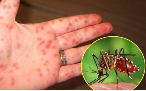 Sốt xuất huyết dễ trở nặng hơn khi từng nhiễm COVID-19