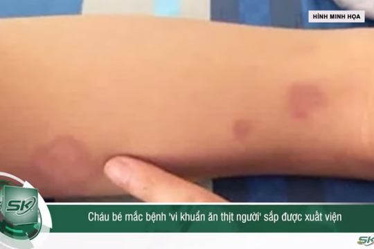 Tình hình sức khỏe của cháu bé nhiễm vi khuẩn ăn thịt người ở Đắk Lắk