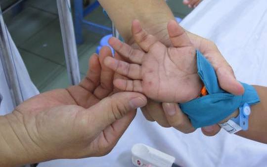 Hà Nội: 1 tuần, số ca tay chân miệng bằng gần 5 tháng đầu năm cộng lại